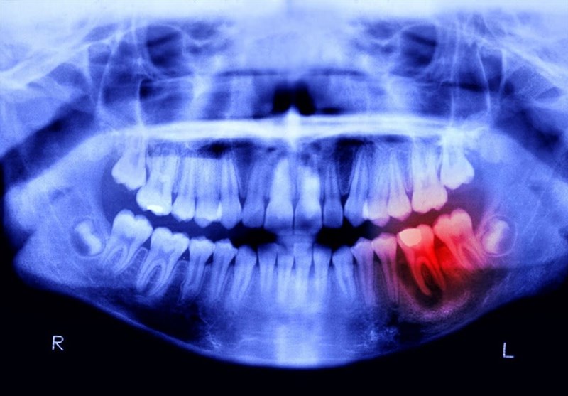 Revolutionary Tooth-Regrowing Drug Enters Human Trials: A Breakthrough in Dental Science!